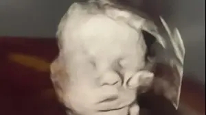 צילום אולטרסאונד של עובר עם יד אלוהים
